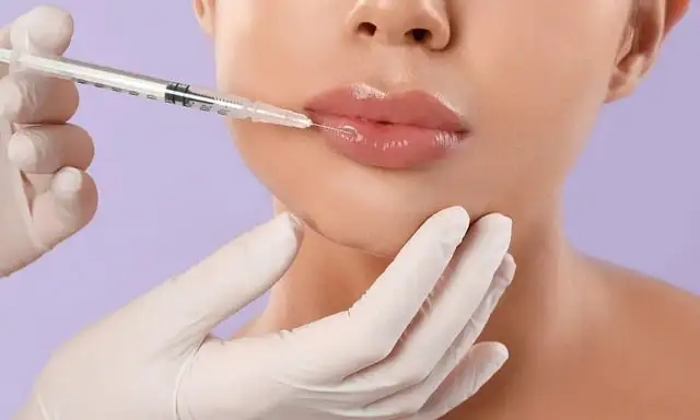lip-filler-injections-in-a-cosmetic-surgery-practice lip filler injections in a cosmetic surgery practice